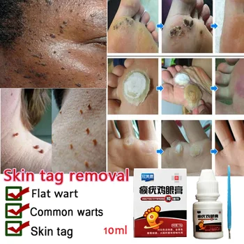10ml Hud Tag Remover Vorte Behandling Papillomas Fjernelse af Væske Mod Pigmentpletter Remover Anti Verruca Afhjælpe Salve
